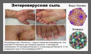 enterovirusnaya-syp2-e1459944309283